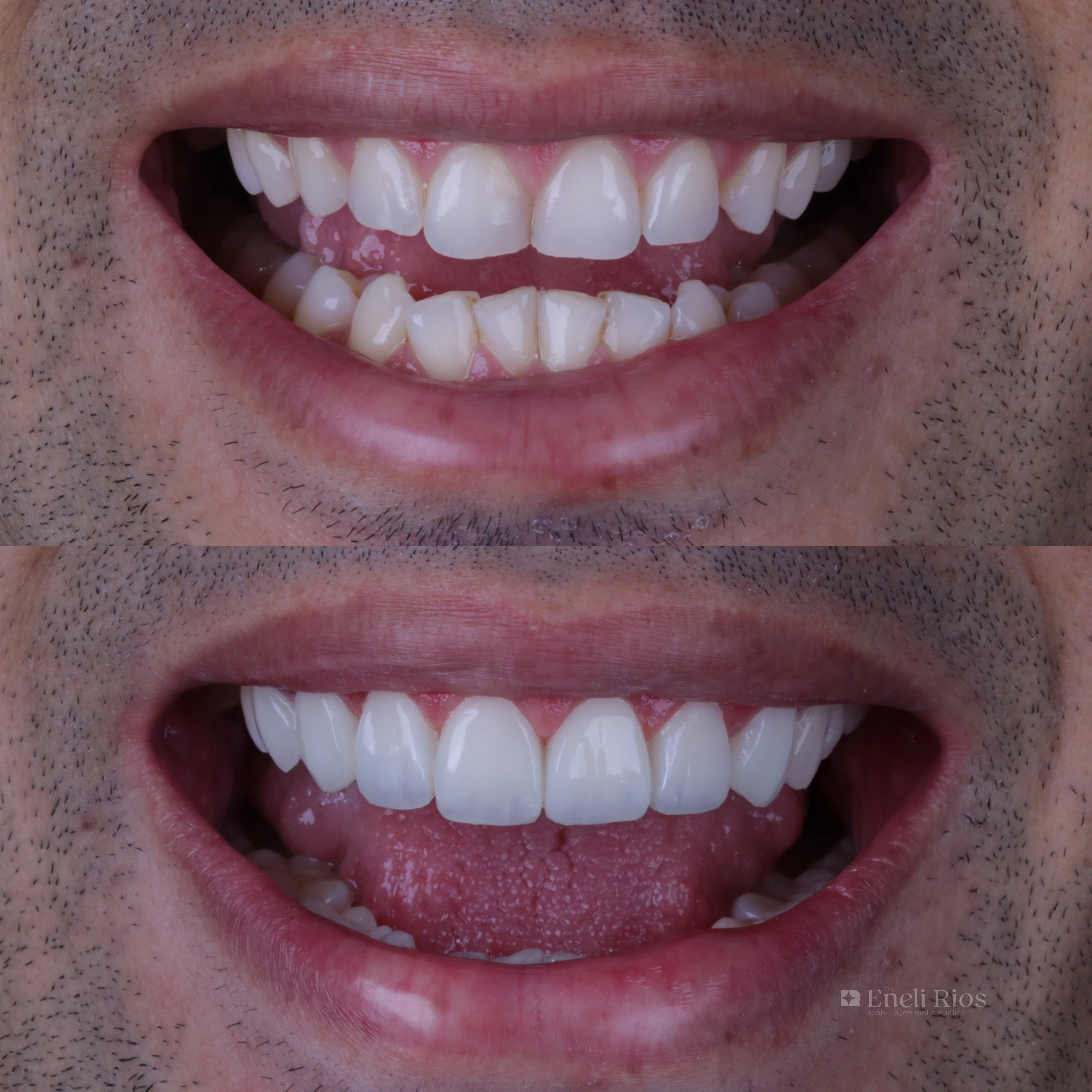Caso de facetas em resina - close do sorriso