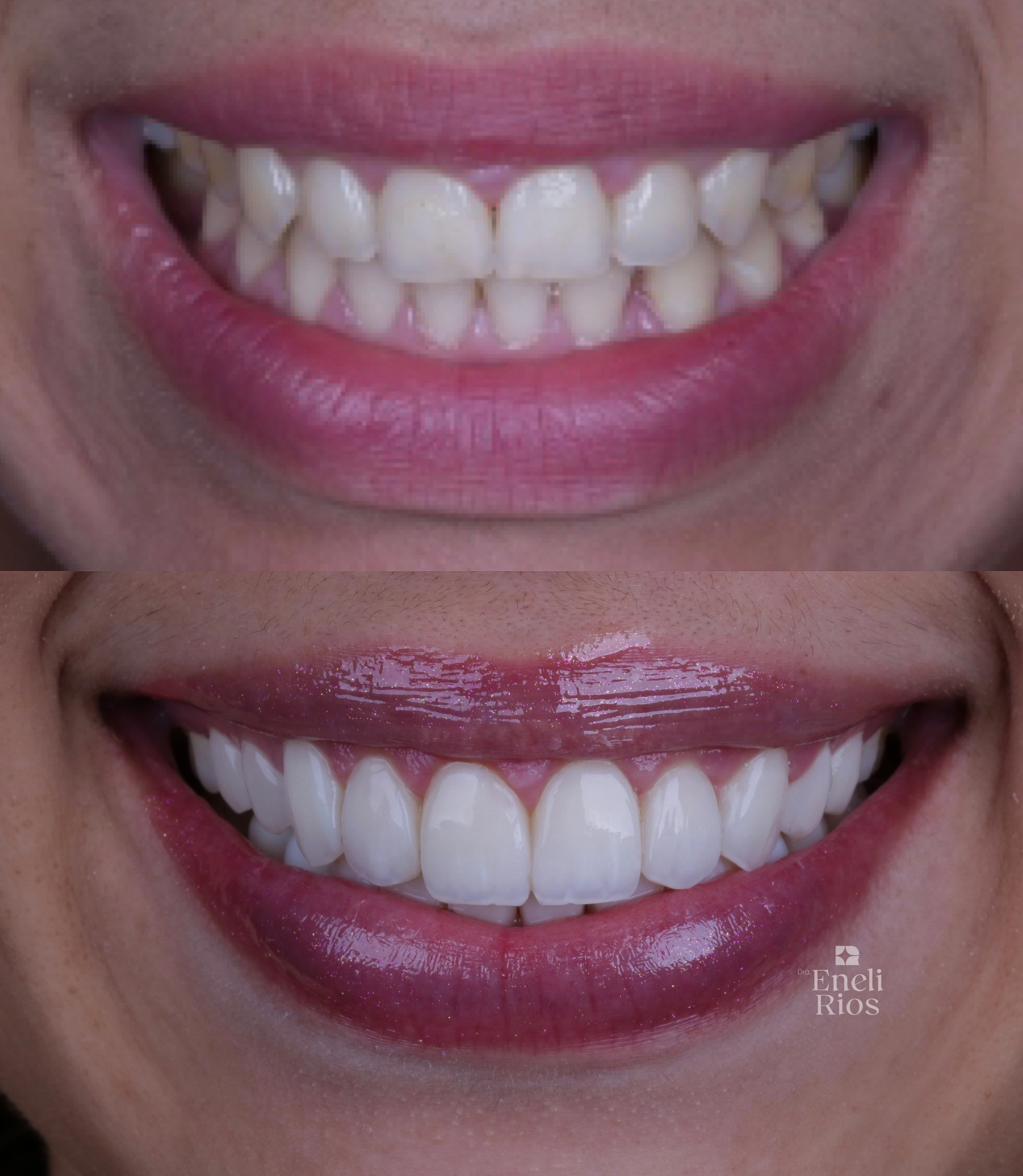 Caso de reabilitação estética