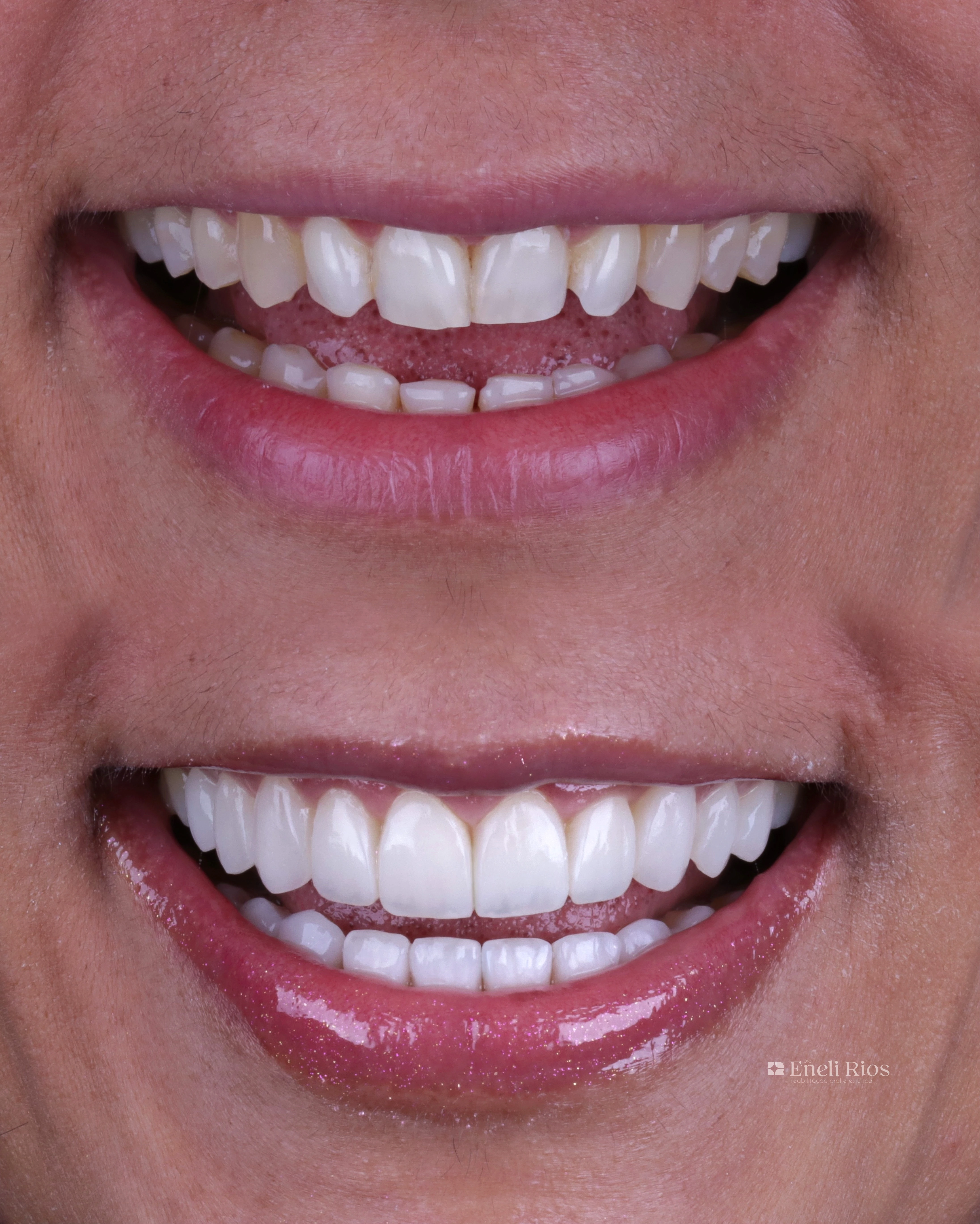 Caso de facetas em resina - close do sorriso
