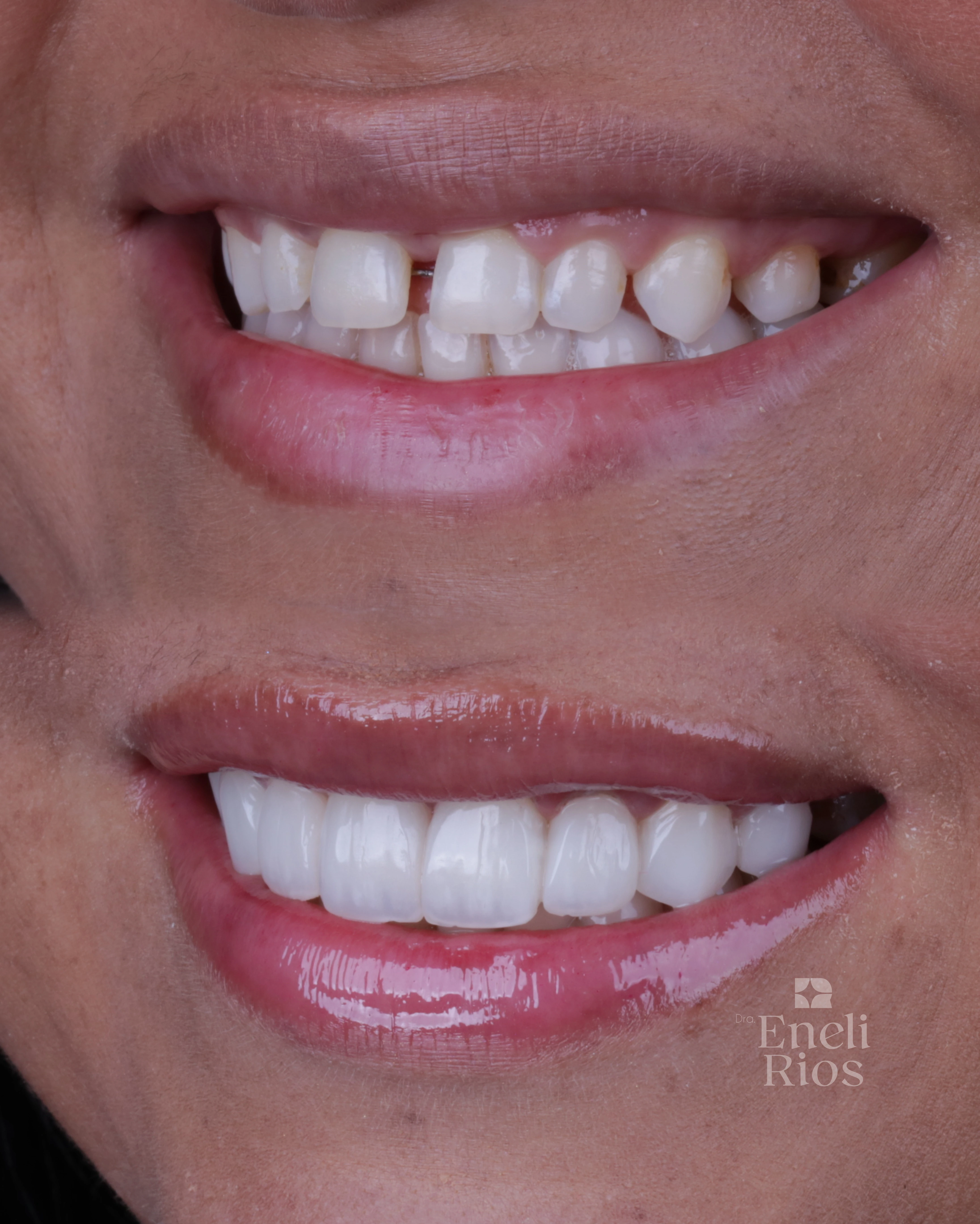 Caso de facetas em resina - close do sorriso