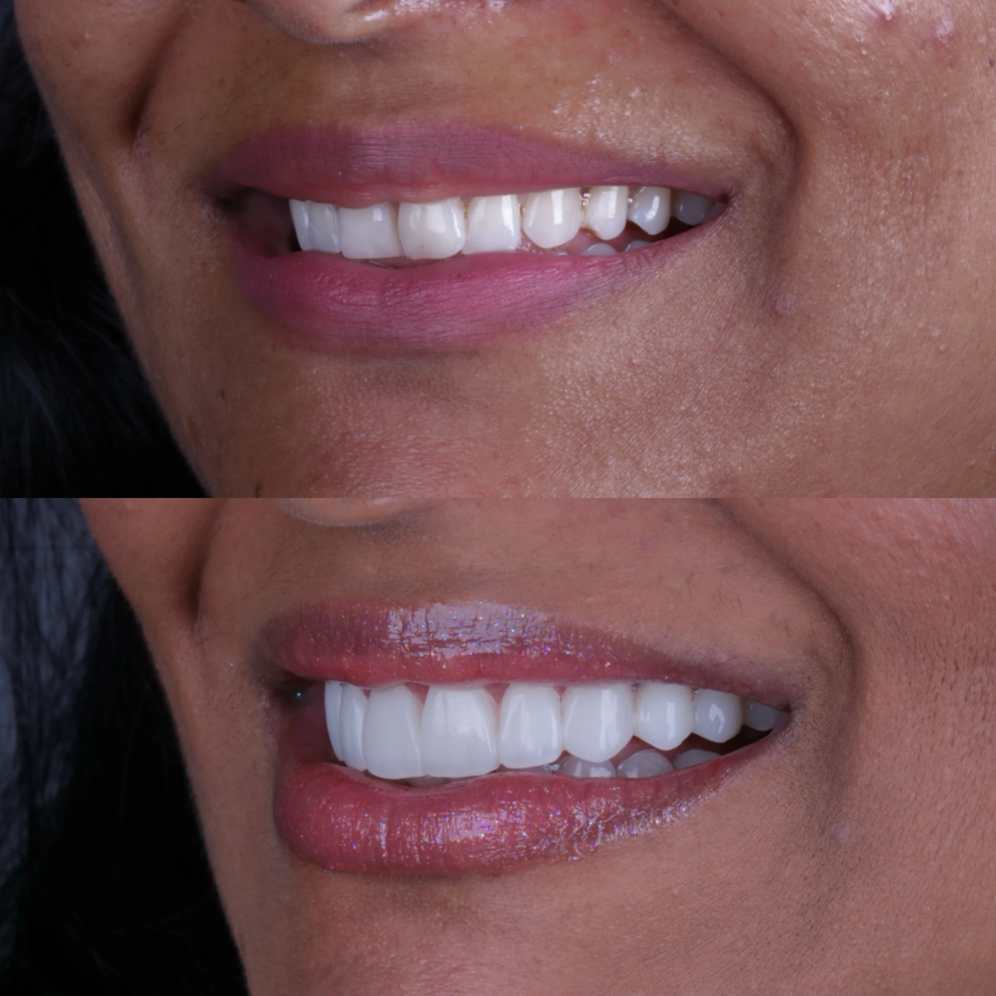 Caso de facetas em resina - close do sorriso